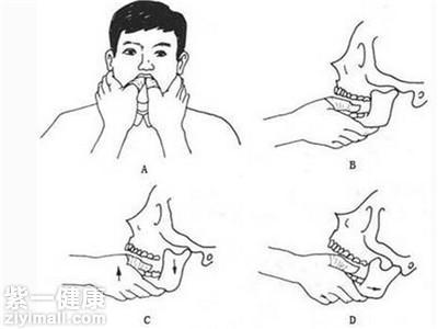 肩关节脱位手法复位 下巴脱位的复位急救措施