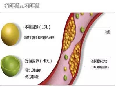 女性胆固醇高的症状 胆固醇高的症状有哪些