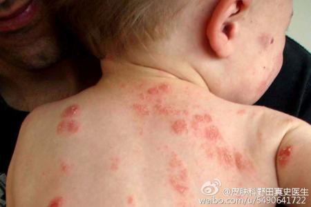 怎样预防冬季湿疹复发 冬季如何预防湿疹