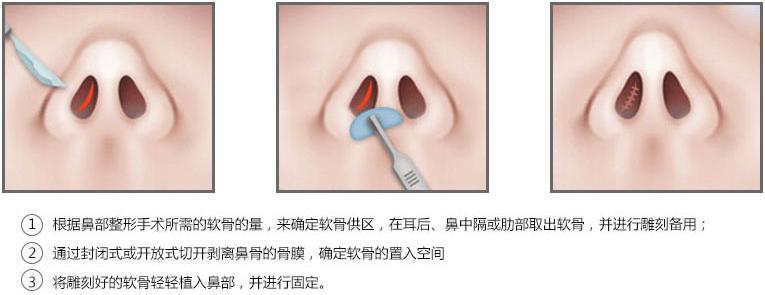 自体软骨隆鼻效果如何 自体软骨隆鼻的效果如何