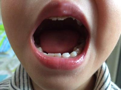 小孩牙齿发黑的原因 小孩牙黑有哪些原因