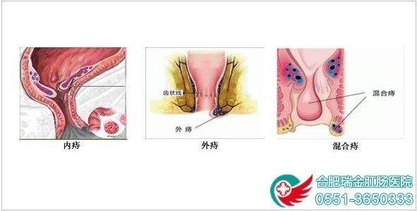 痔疮危害 痔疮对人体有那些危害