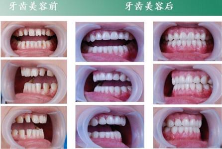 牙齿稀疏怎么矫正 稀疏牙是什么