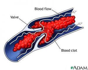 血栓的类型 血栓形成的条件