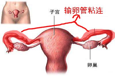 输卵管粘连竟然怀孕了 输卵管粘连有什么症状