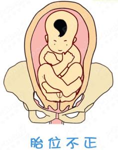 胎位不正胎儿会畸形吗 胎位不正对胎儿有影响吗