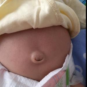 两个月婴儿脐疝怎么办 宝宝脐疝该怎么办