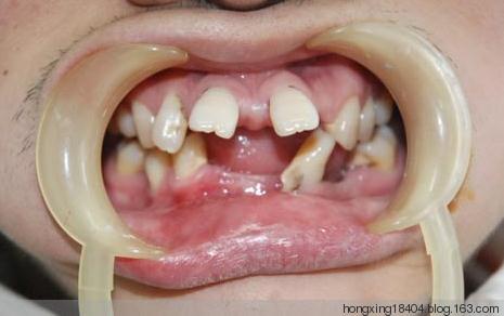 牙齿突然出血什么预兆 外突牙有哪些预兆吗