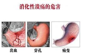 胃溃疡最佳治疗方案 胃溃疡的治疗方法