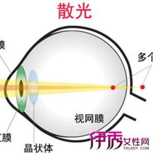 青光眼是怎样形成的 散光眼是怎样形成的