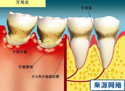 牙周病症状图片 牙周病症状