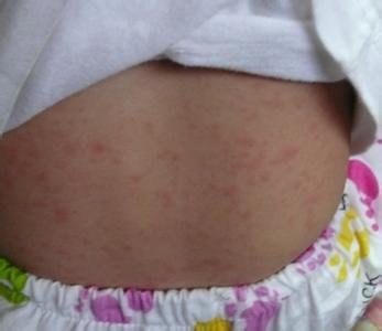 幼儿急疹护理方法 5种方法可用于护理幼儿急疹