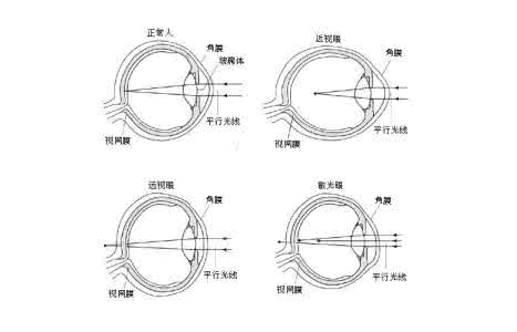 散光眼怎么恢复 散光怎样形成的