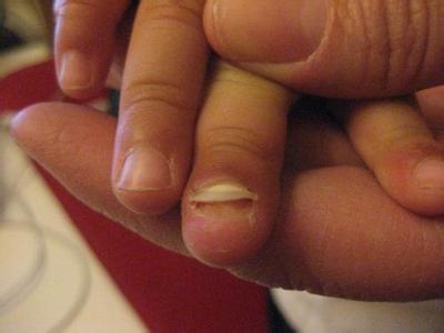 手指被夹淤血怎么处理 宝宝手指夹到了怎么处理