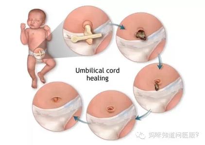 宝宝脐带护理 宝宝脐带该怎样护理