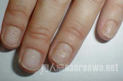 指甲竖纹预示什么疾病 指甲上有竖纹预示什么_指甲上有竖纹预示有病变_指甲上有白点的原因