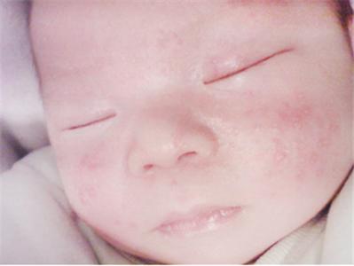 口水疹和湿疹的区别 宝宝口水疹跟湿疹的区别