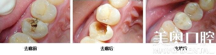补牙后牙齿酸痛正常吗 补牙后牙齿酸痛正常吗 补牙后牙齿酸痛怎么办