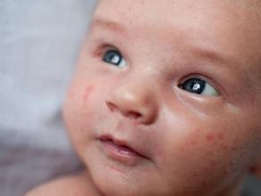 宝宝皮肤过敏症状图片 宝宝皮肤过敏怎么办