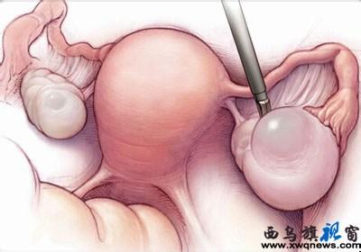 卵巢囊肿的症状及治疗 卵巢囊肿的治疗方法_卵巢囊肿的症状