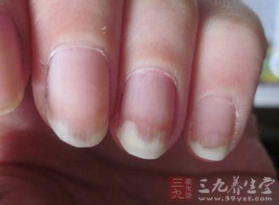 灰指甲最佳治疗方法 灰指甲的治疗方法有哪些_治疗灰指甲的最佳方法