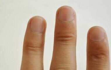 治疗灰指甲的最佳偏方 灰指甲的治疗方法