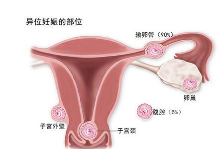 宫外孕大出血急救ppt 宫外孕的急救方法