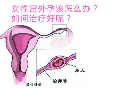 宫外孕大出血急救ppt 宫外孕急救方法