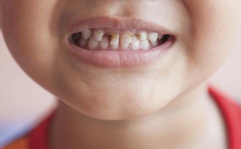 小孩子蛀牙痛怎么办 孩子蛀牙怎么办？