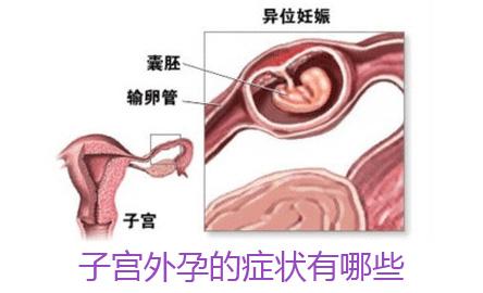 如何自我排除宫外孕 如何判断宫外孕