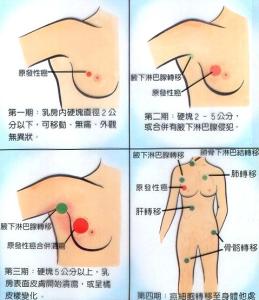 乳腺癌患者生活计划 生活中被错判的乳癌杀手