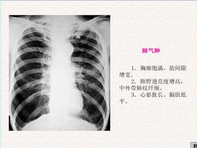 肺气肿肺心病治疗 肺气肿是什么病 什么是肺气肿 肺气肿治疗