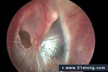 耳膜穿孔症状 耳膜穿孔的症状_耳膜穿孔的预防及检查