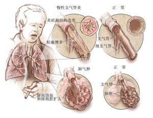 抽烟对肺部的危害 抽烟对肺部组织的危害