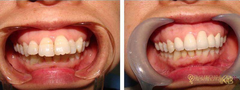 牙齿常见疾病 龅牙怎么办_牙齿有哪些常见的疾病