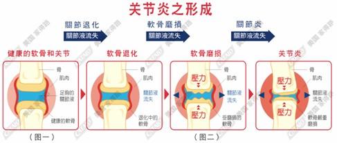 关节痛的原因及治疗 关节痛的原因有哪些 关节痛的治疗方法有哪些