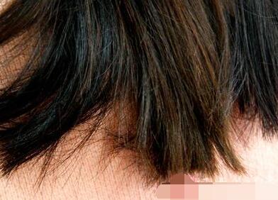 女性脱发的原因及治疗 脱发怎么治疗最好 脱发原因有哪些