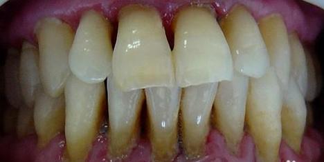 如何预防牙周炎 牙周炎能不能治好_如何预防牙周炎