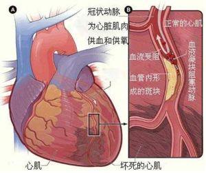 急性心肌梗塞 夏季导致急性心肌梗塞的原因有哪些