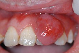 牙龈肿痛吃什么食物 保护牙龈的食物_牙龈肿痛怎么办才好