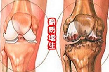 膝关节骨质增生偏方 骨质增生的治疗方法_治骨质增生的偏方_骨头增生怎么治疗