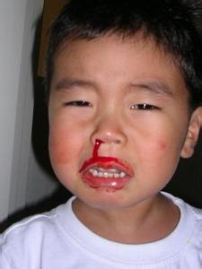 儿童鼻子经常出血偏方 儿童鼻子出血怎么办