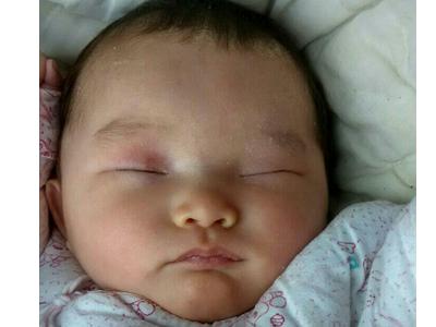 新生儿睡眠注意事项 新生儿泪囊炎的注意事项