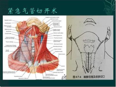 气道异物梗阻急救法 喉梗阻怎么急救