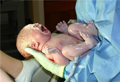 新生儿脐带脱落后出血 新生儿脐带脱落后如何预防出血