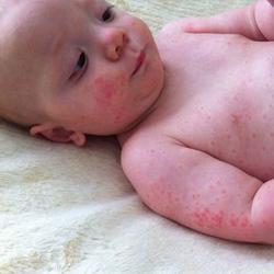 新生儿风疹 新生儿风疹是什么