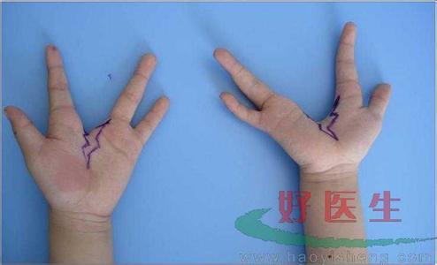 小孩先天性手指畸形 手部先天畸形怎么回事