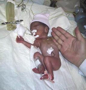 新生儿呼吸窘迫综合征 新生儿呼吸窘迫综合征的治疗