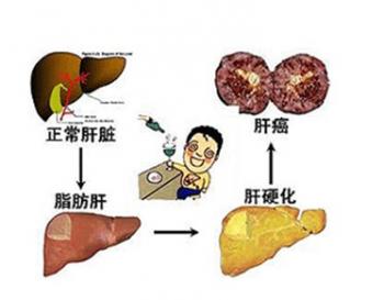 脂肪肝的治疗方法 脂肪肝怎么治疗_脂肪肝治疗方法有哪些