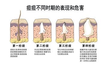 出水痘时哪个阶段最痒 不同阶段该如何克痘